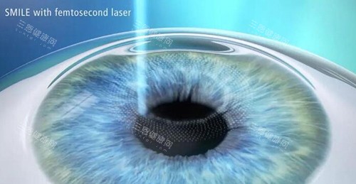 眼睛飞秒激光照片 眼睛飞秒激光照片