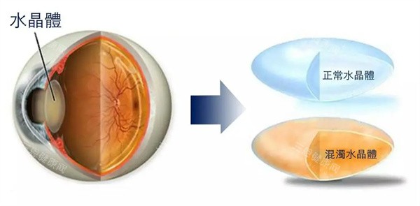 眼睛水晶体混浊照片 眼睛水晶体混浊照片