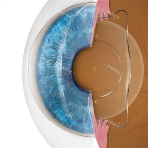 沃丽汀治疗玻璃体混浊多久起效？飞蚊症成功概率多高？眼科医师详细解答！