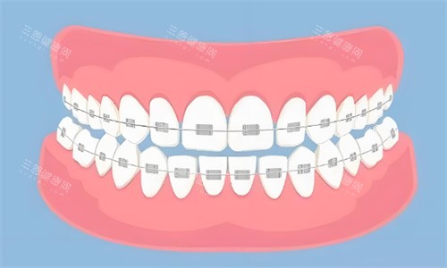 金属矫正牙齿