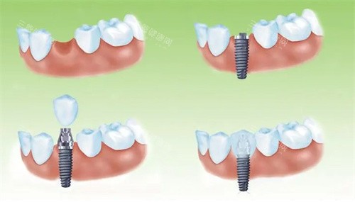 种植牙过程 种植牙过程