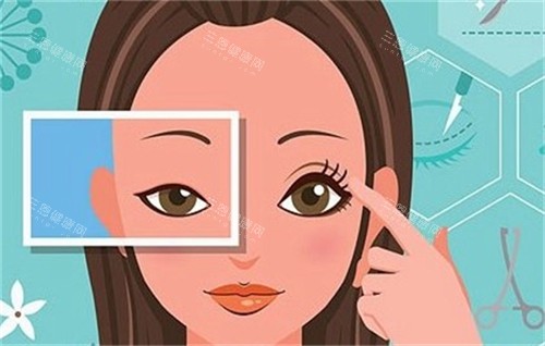 双眼皮手术前后对比 双眼皮手术前后对比