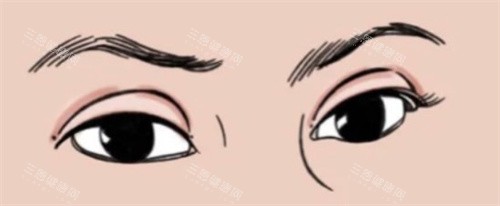 双眼皮肉条感 双眼皮肉条感