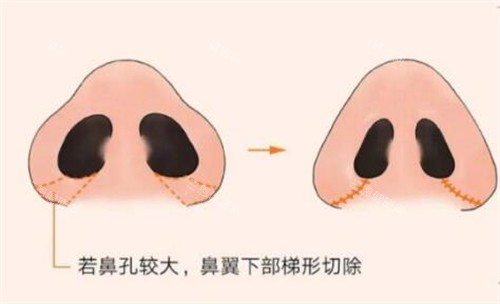 鼻翼缩小手术操作 鼻翼缩小手术操作