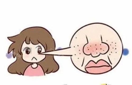 鼻子部位毛孔粗大示意图 鼻子部位毛孔粗大示意图