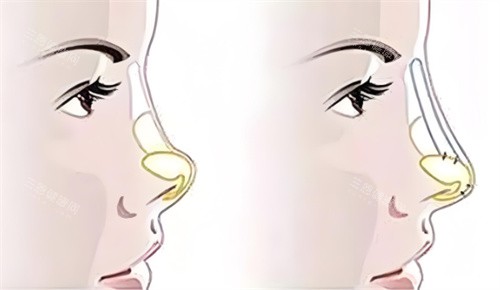 朝天鼻矫正术鼻部对比 朝天鼻矫正术鼻部对比