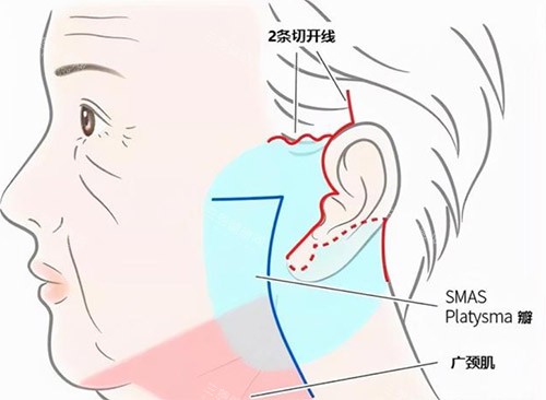 拉皮术后如何快速消肿？实用冰敷、饮食与作息建议助您平稳度过改善期！