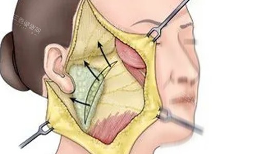拉皮手术剖开动画示意图 拉皮手术剖开动画示意图