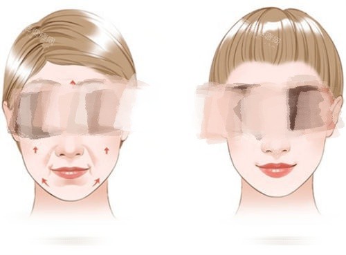 拉皮手术提拉方向示意图.jpg 拉皮手术提拉方向示意图.jpg