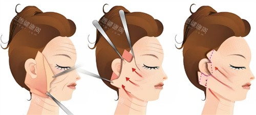 拉皮手术过程图