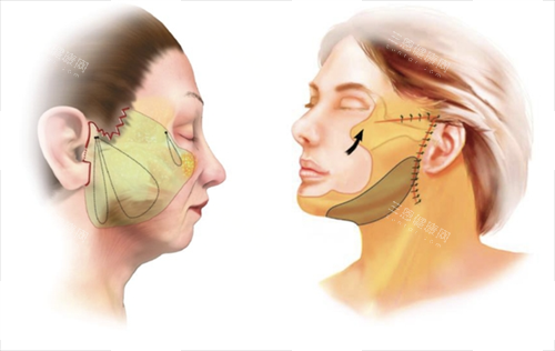 拉皮手术面部脂肪组织区域圈画图