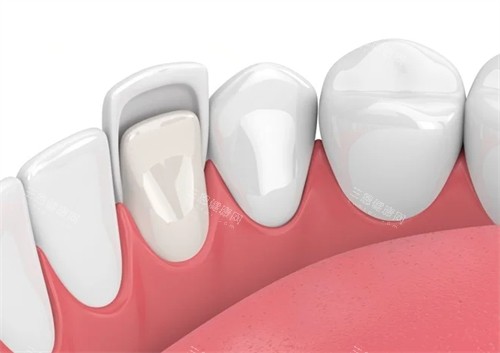 牙齿贴面在口腔内的样子 牙齿贴面在口腔内的样子