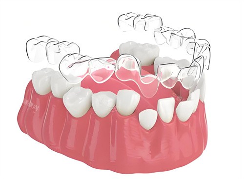 牙齿隐形矫正图片 牙齿隐形矫正图片