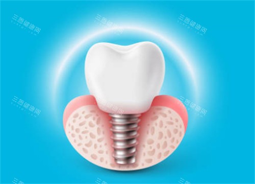种植牙有光圈示意图 种植牙有光圈示意图