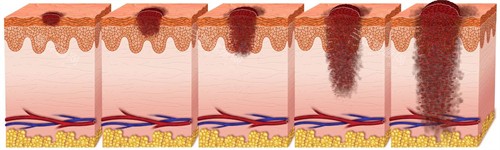 不同深度的疤痕 不同深度的疤痕