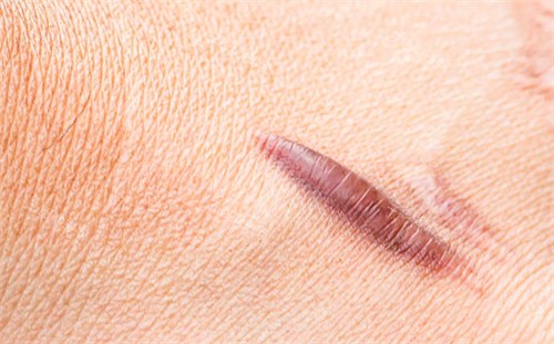 疤痕疙瘩2 疤痕疙瘩2