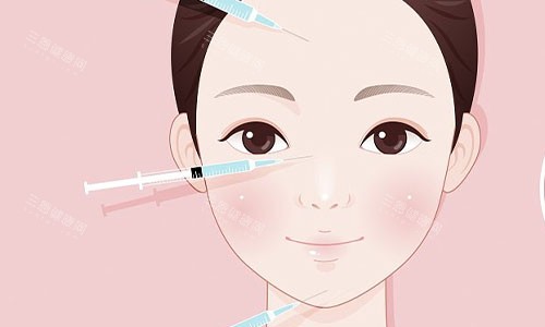 注射美容的部位示意图 注射美容的部位示意图