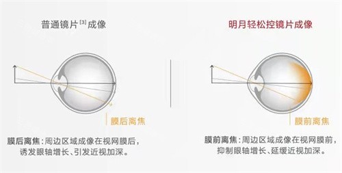 明月轻松控镜片成像 明月轻松控镜片成像