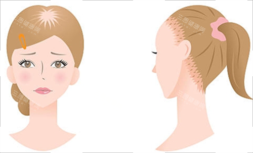 女生脱发类型 女生脱发类型