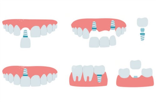 2025-2026宜宾市第二人民医院口腔科价格表解读：种植牙3980起|矫正9800起，补牙/拔牙可报销，收费透明无套路