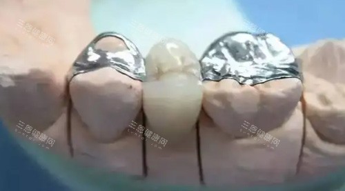 镶牙治疗细节图 镶牙治疗细节图