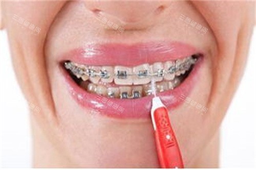 正在做正畸的牙齿宣传图 正在做正畸的牙齿宣传图