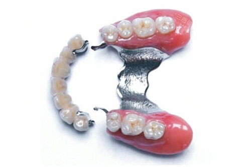 精密附着体和活动义齿成品 精密附着体和活动义齿成品