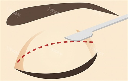 双眼皮的切口切线 双眼皮的切口切线