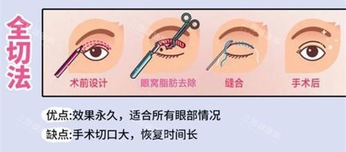 双眼皮手术全切法动画演示图 双眼皮手术全切法动画演示图