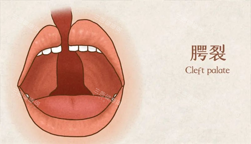 孟宪勇医生个人简介大公开！郑州坐诊医院唇腭裂免费手术申请攻略，速看具体流程！