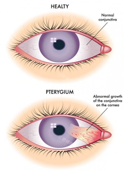 正常眼睛和翼状胬肉眼睛 正常眼睛和翼状胬肉眼睛