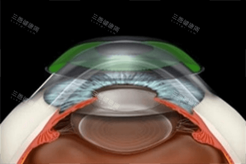 角膜塑形镜原理示意图 角膜塑形镜原理示意图