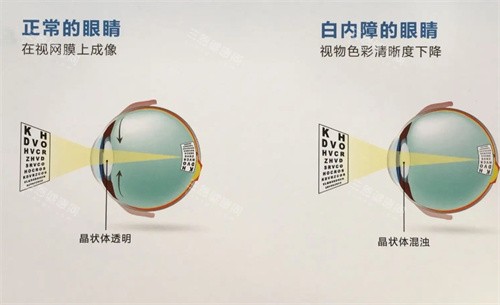 正常眼睛和白内障眼睛的对比图 正常眼睛和白内障眼睛的对比图