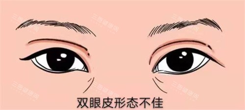 双眼皮修复示图 双眼皮修复示图