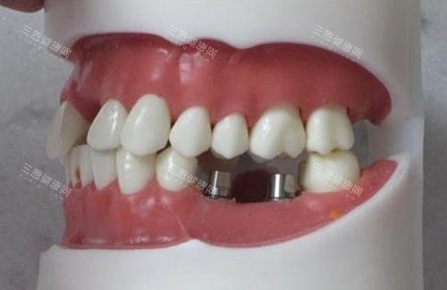 需要种牙的牙齿情况图 需要种牙的牙齿情况图