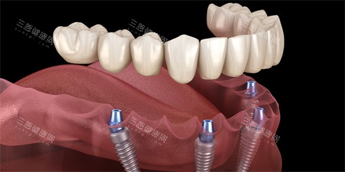 半口种植牙图示 半口种植牙图示