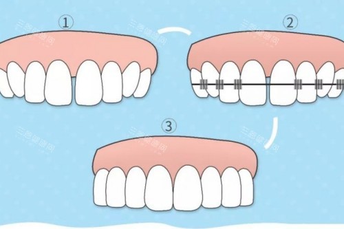 牙齿矫正步骤图 牙齿矫正步骤图