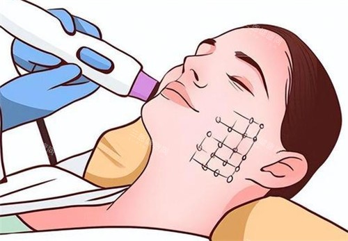 2025广州热玛吉正规授权医院名单：10家认证机构+价格全解析