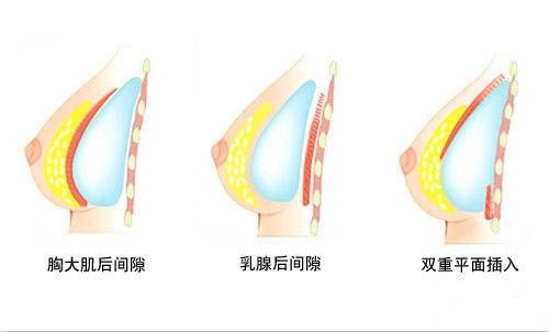 隆胸假体植入方式示意图 隆胸假体植入方式示意图