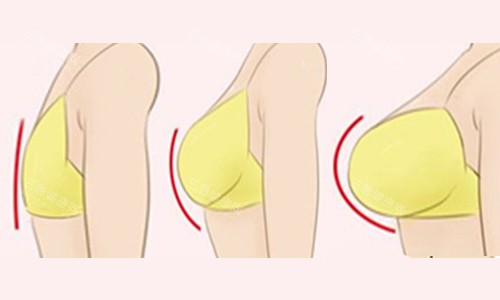 隆胸尺寸对比 隆胸尺寸对比