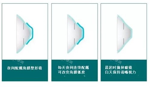 角膜塑形镜的原理 角膜塑形镜的原理