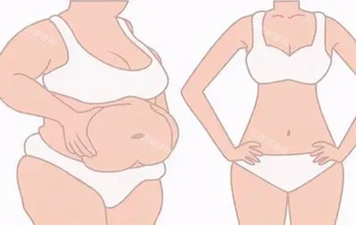 全身吸脂前后对比示意图 全身吸脂前后对比示意图