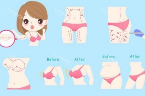 吸脂塑形概念图 吸脂塑形概念图