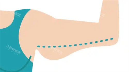 手臂吸脂前 手臂吸脂前