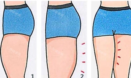 吸脂前后对比动画图 吸脂前后对比动画图