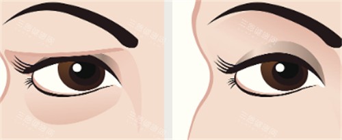 郑州王杨医生眼袋修复卧蚕多少钱？1万元起的价格明细都在这，结果对比图超惊艳！