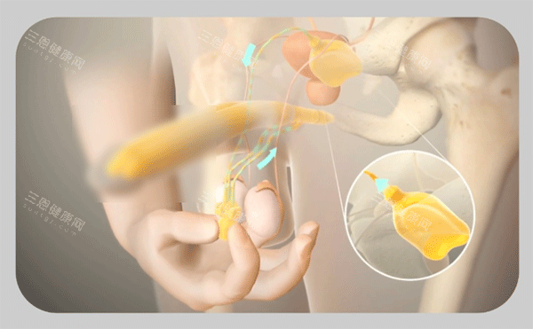 男性阴茎假体植入三件套手术过程 男性阴茎假体植入三件套手术过程