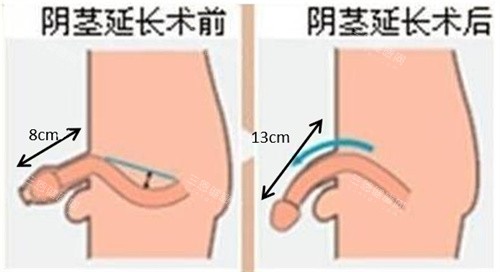 阴茎增长手术前后对比动画图 阴茎增长手术前后对比动画图