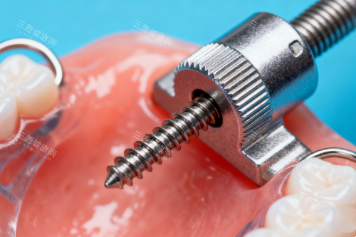 牙齿保持器安装图片一览 牙齿保持器安装图片一览