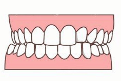牙齿轻微畸形卡通图 牙齿轻微畸形卡通图